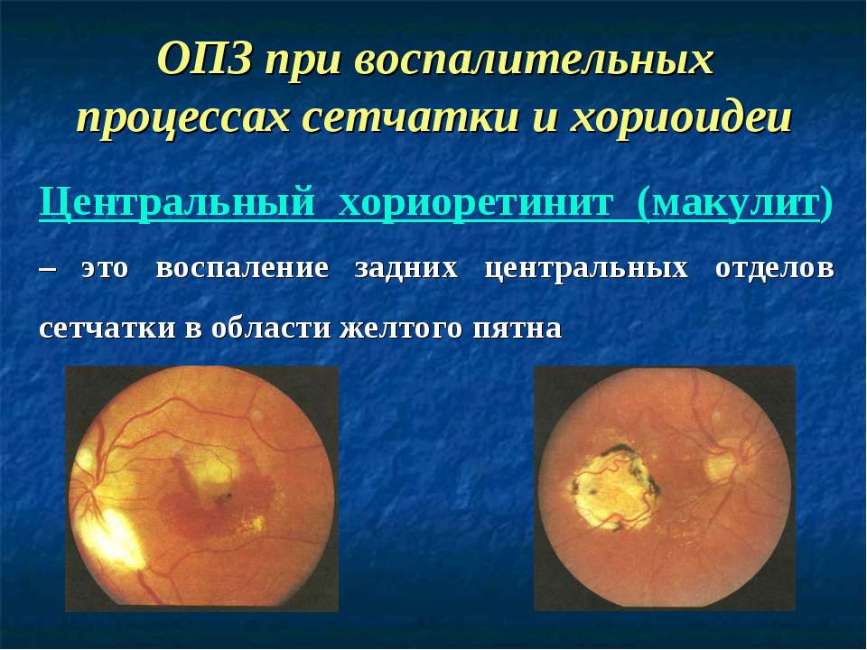 Retinitis( radang retina): Gejala dan Pengobatan