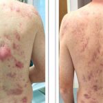 Akne conglobata: was ist das, Symptome, Fotos, Behandlung, Prognose