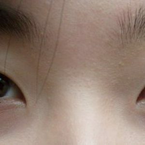 Aasia silma lõikus: kirurgia, blepharoplasty