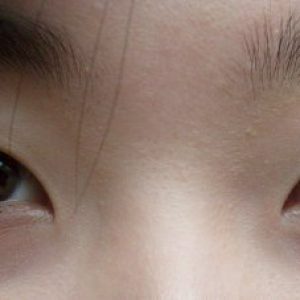 Asian Augen Schnitt: Chirurgie, blepharoplasty