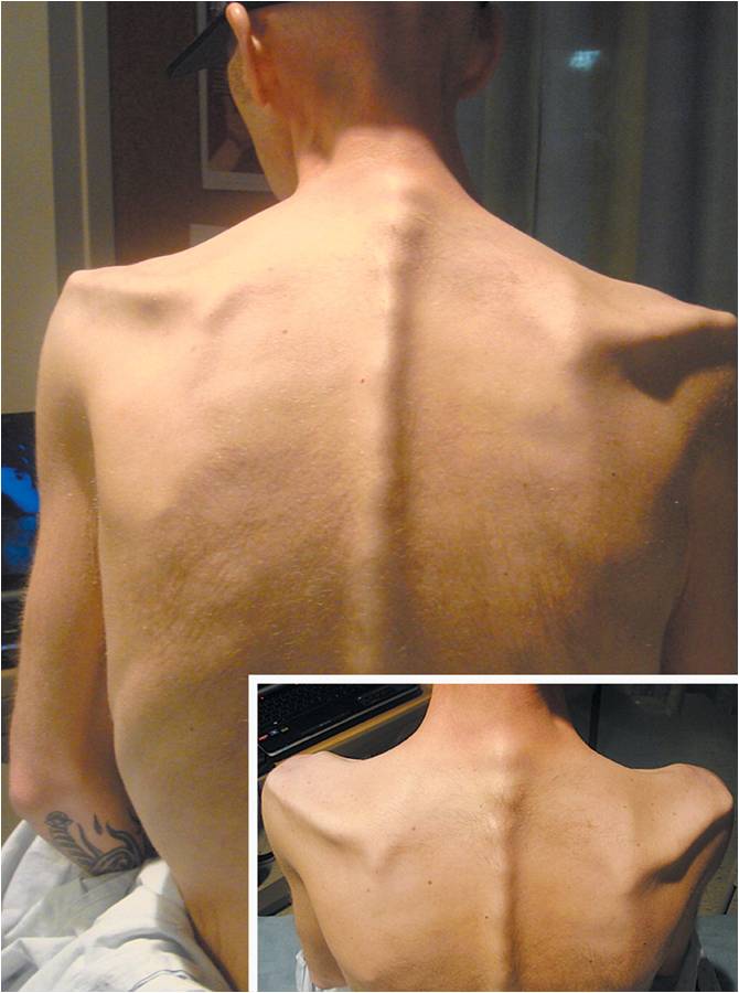 Neurogene Anorexie: Was ist das, Ursachen, Symptome, Behandlung, Prognose
