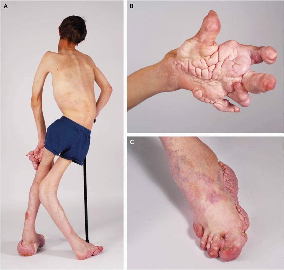 Proteus-Syndrom: Was ist das, Ursachen, Symptome, Behandlung, Prognose