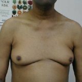 Männer Brust Brust Chirurgie