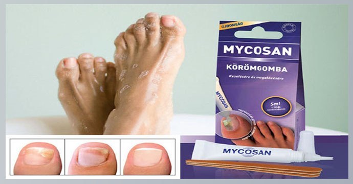 Mycosan na grzybicę paznokci: recenzje, cena, instrukcje użytkowania