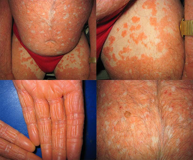 Deverji-Krankheit (Pityriasis Pityriasis): Ursachen, Symptome und Behandlung