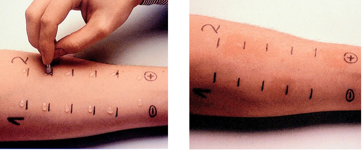Allergen test (allergy tests): how to prepare, types, indications