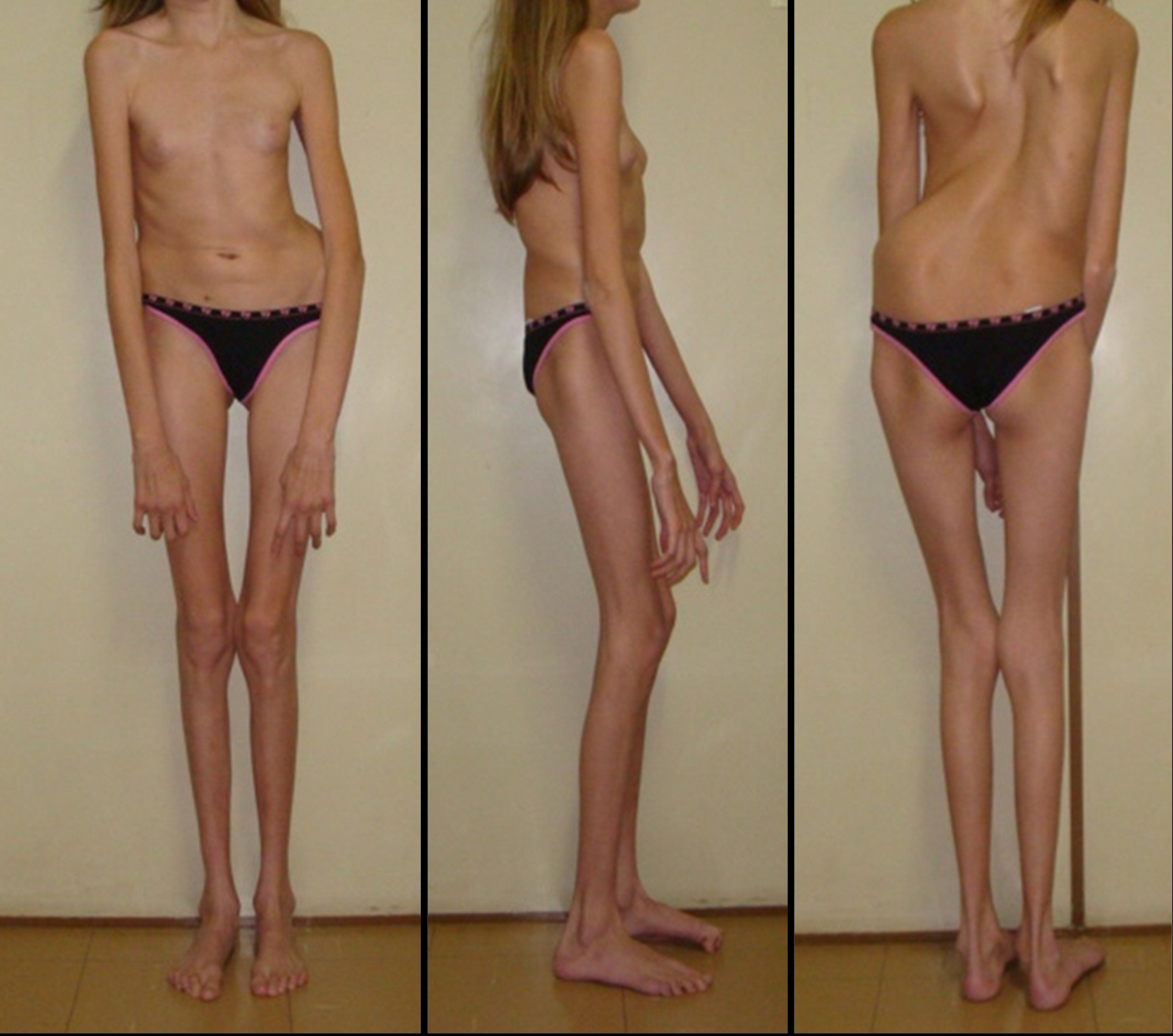 Marfan syndrome: photos of patients, causes, symptoms and treatment