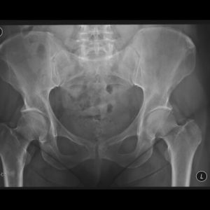 Enostosis: co je to?