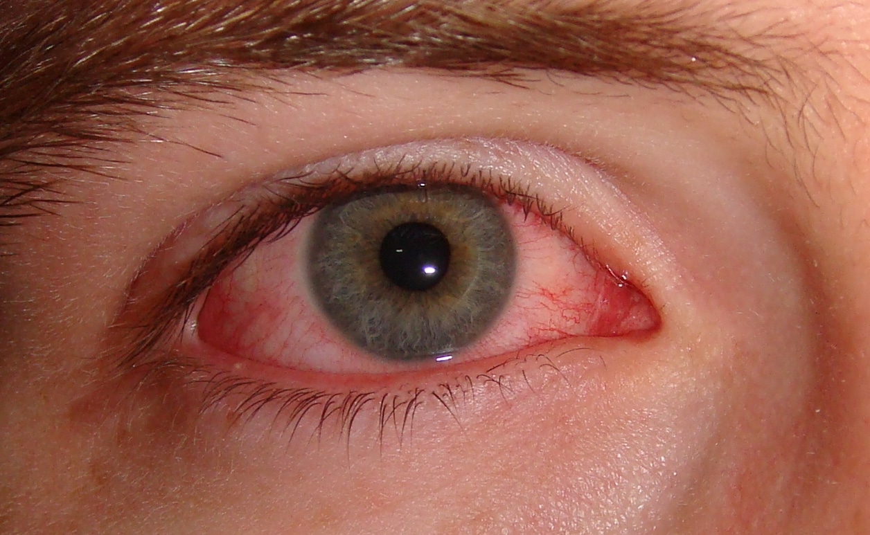 Konjunktivitis: simptomi (fotografija) i liječenje kod odraslih i djece