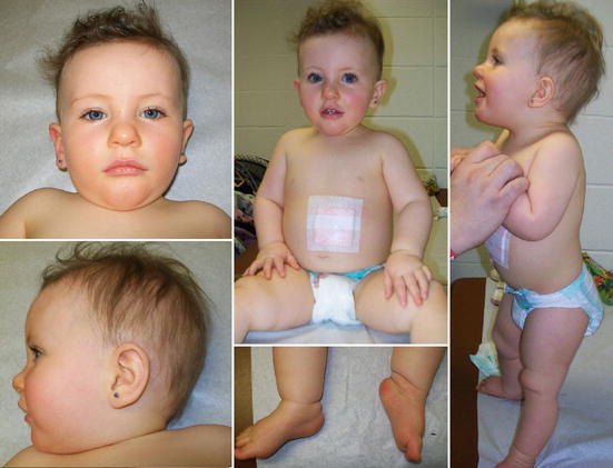 Prader-Williho syndrom u dětí: co to je, příznaky, fotografie, léčba