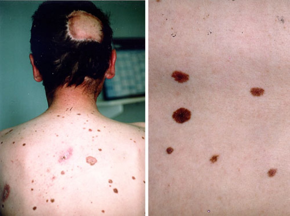 Nevi: Grundtypen, die Grundsätze der Diagnose, Prävention von Melanomen