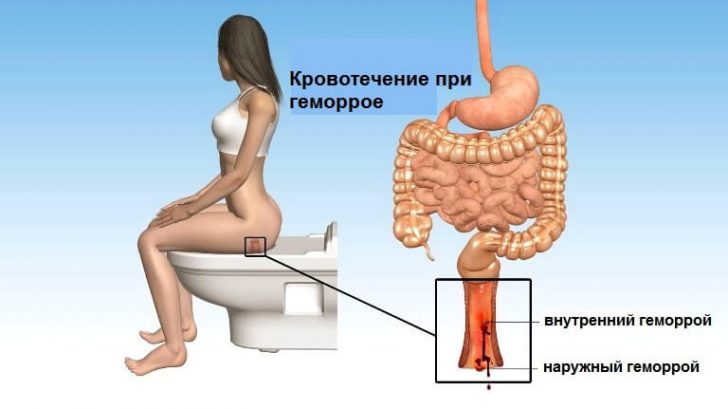 Hemorrhoidal asiņošana: kā lai apturētu asiņošanu hemoroīdi