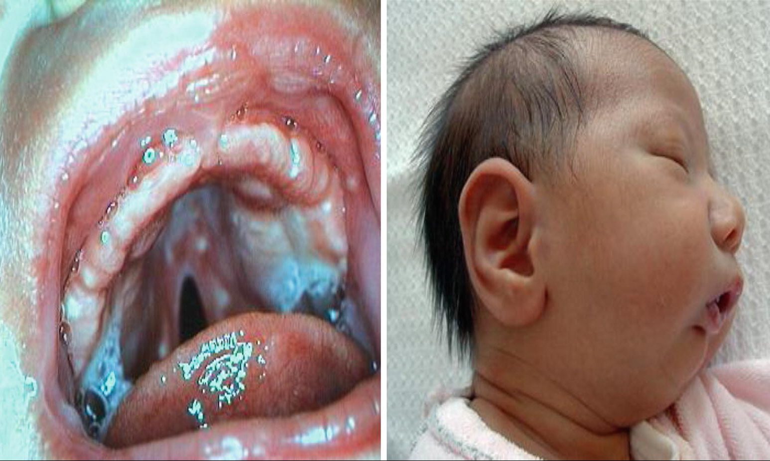 Pierre-Robin-Syndrom: Was ist das, Symptome, Behandlung, Prognose?