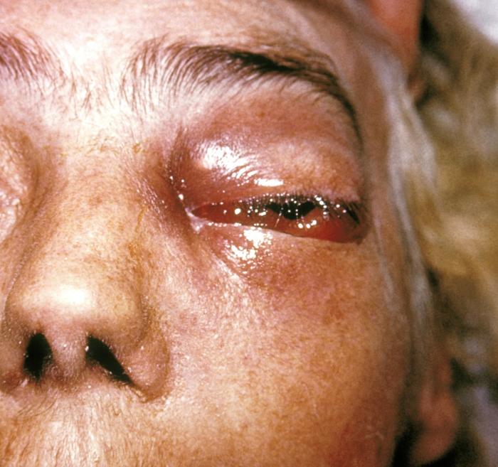 Mukomykose: Was ist das, Ursachen, Symptome, Behandlung, Prognose