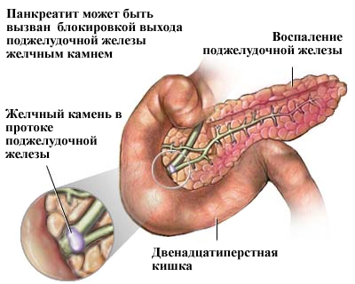 Pankreatitis - Entzündung der Bauchspeicheldrüse