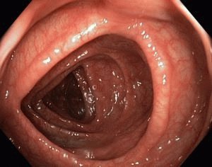 Endoscopie intestinale