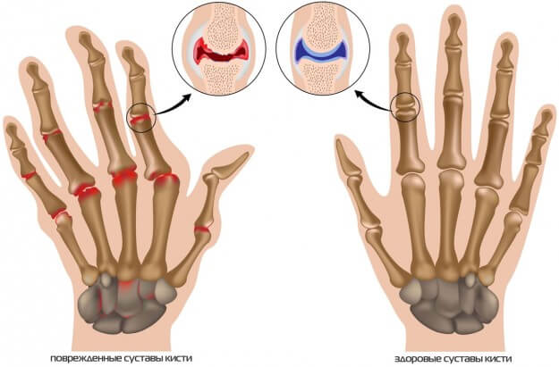 Sore Finger: was zu tun ist?