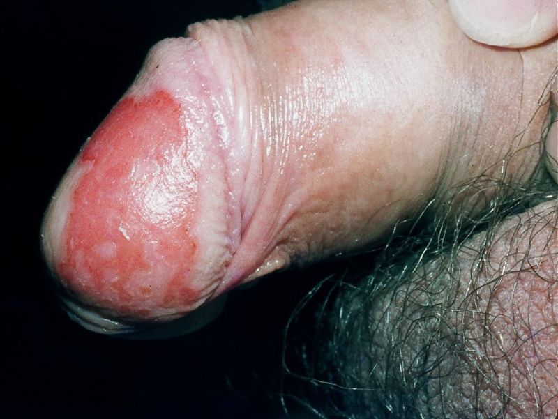 Balanitis: was ist das, Symptome, Behandlung, Prognose, Komplikationen