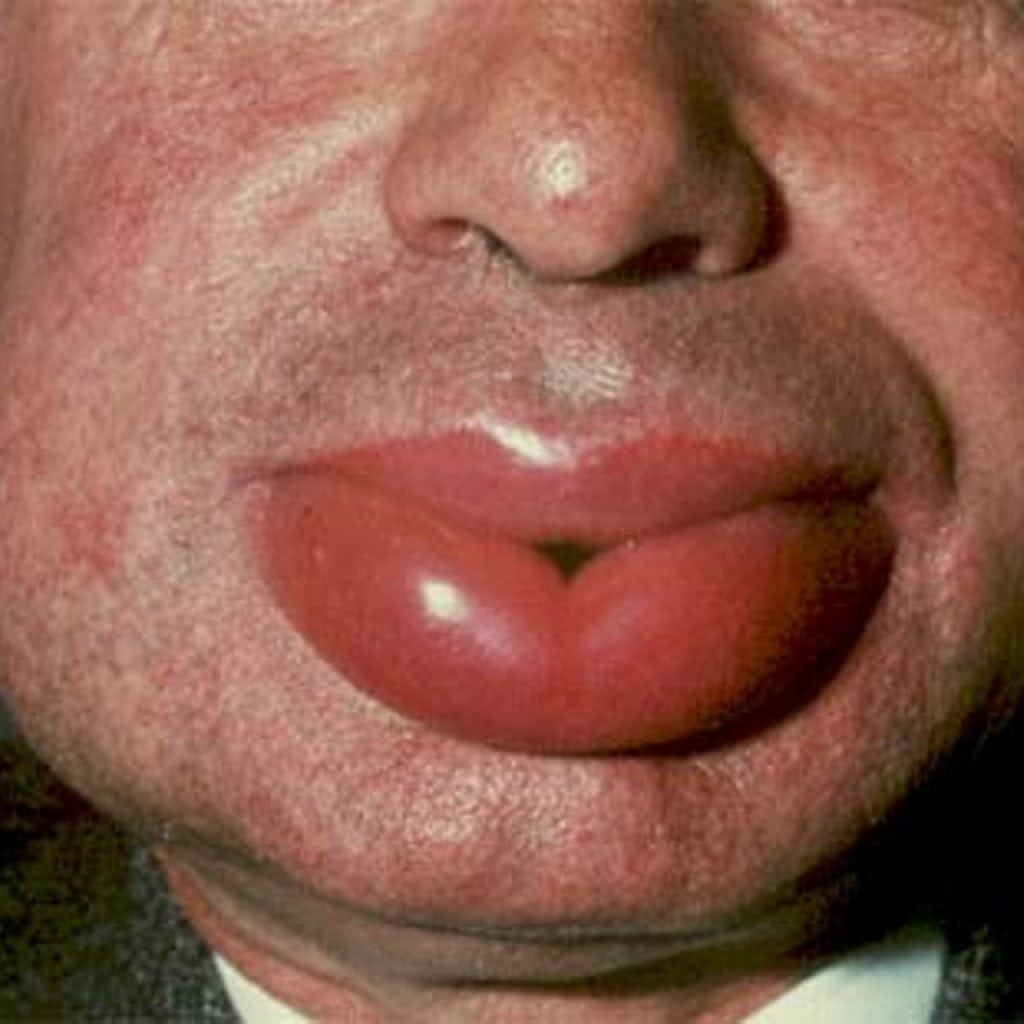 Anaphylactic shock: causes, symptoms, emergency care