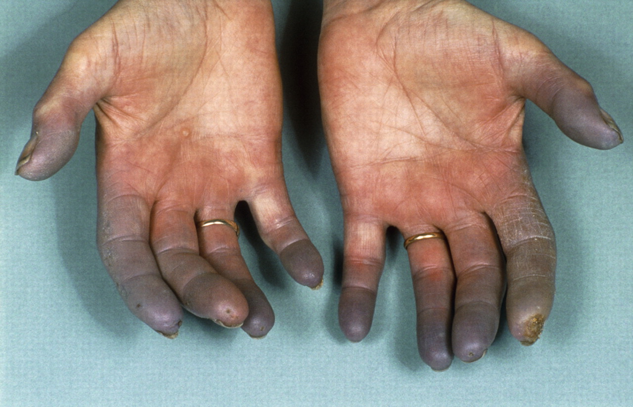 Systemisk skleros: symptom, orsaker, diagnos och behandling