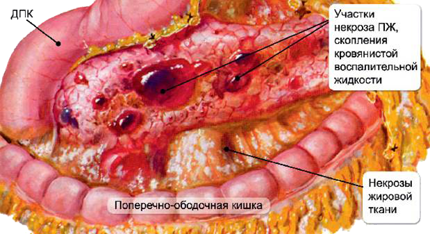 Metody leczenia martwicy trzustki trzustki