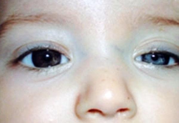 Horner-Syndrom: Was ist das, Symptome, Behandlung, Prognose