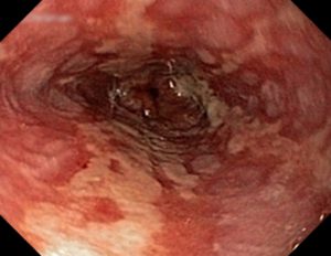 Reflux-Ösophagitis