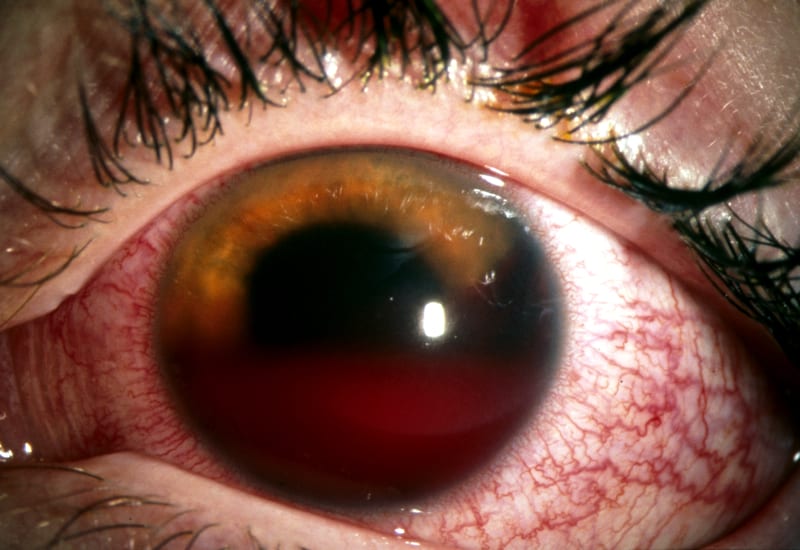 Hyphema: Was ist das, Ursachen, Symptome, Behandlung, Prognose