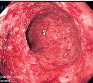 Colitis i tarmene