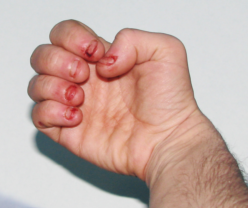 Lesch-Nihan-syndroom: wat is het, symptomen, behandeling, prognose?