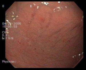 Akut gastritis