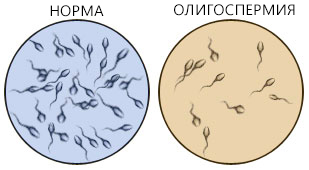 Oligospermie - Ursachen, Behandlung, Folgen und die Wahrscheinlichkeit der Empfängnis