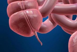 Può esserci appendicite una seconda volta: sintomi simili di altre malattie