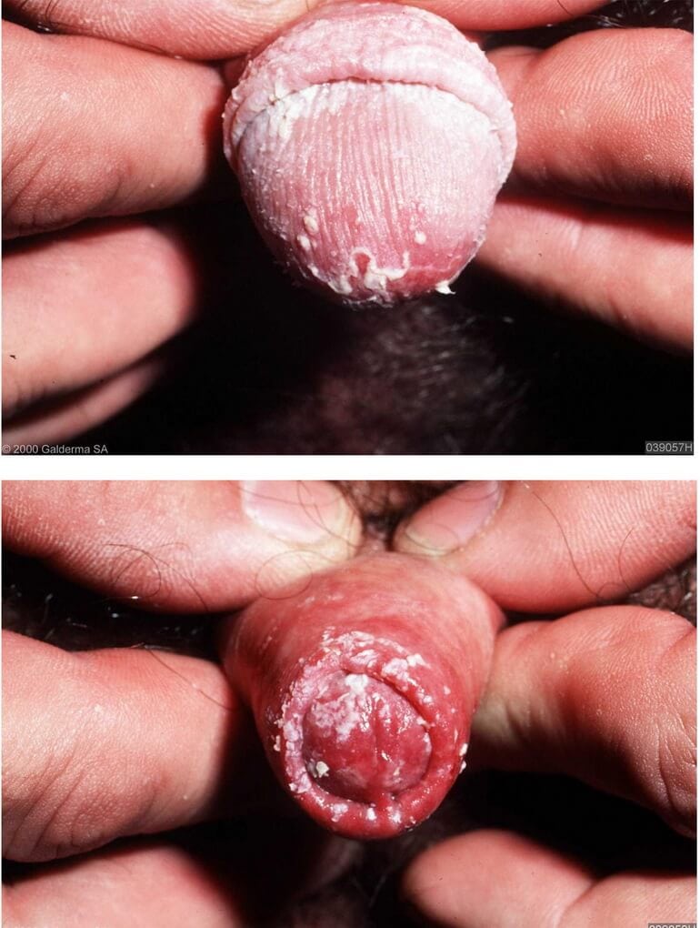 Candidiasis en hombres: fotos, síntomas y tratamiento.
