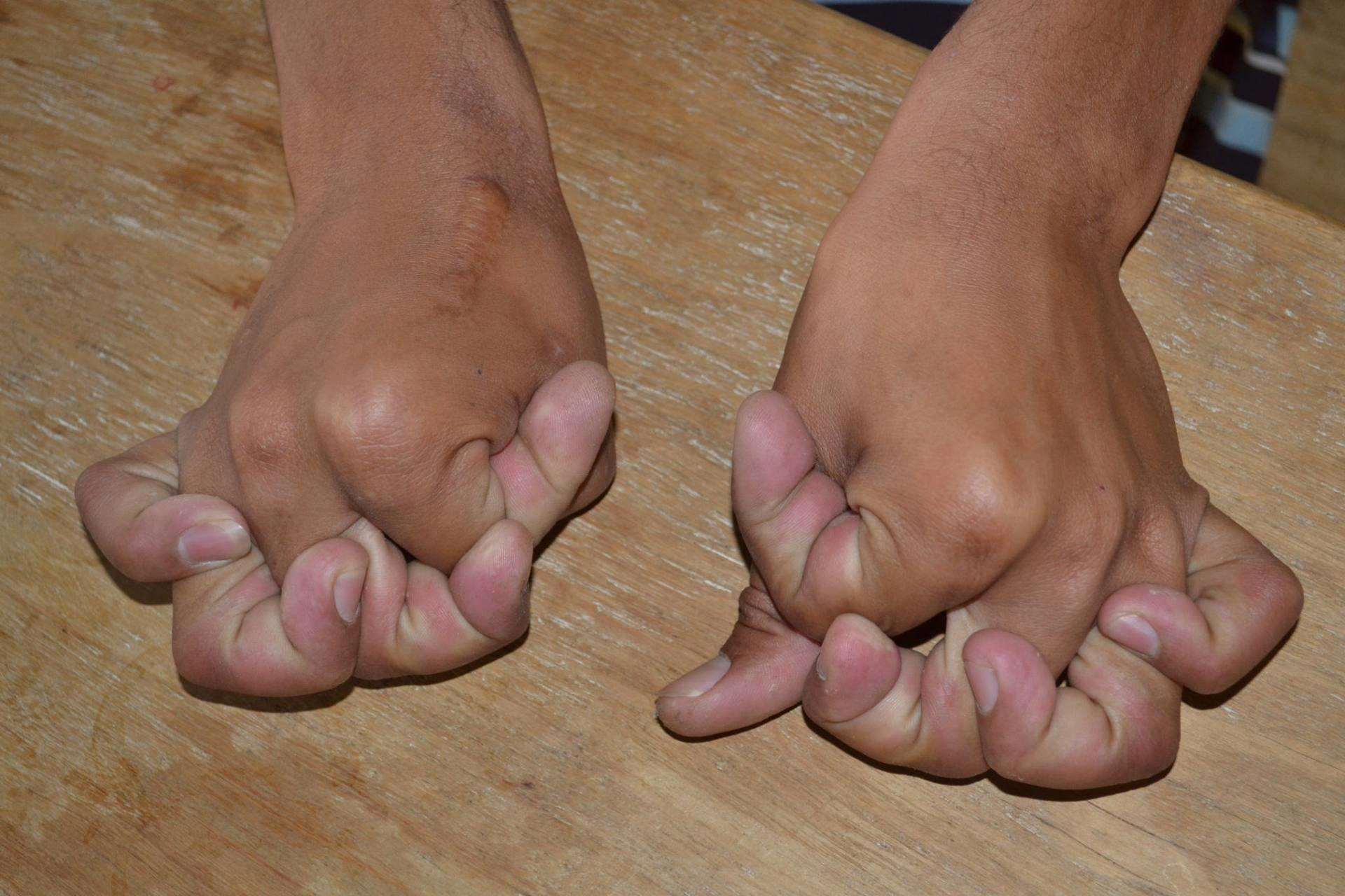 Kosti a klouby se s nemocí stávají hyperelastickými (7 fotografií)