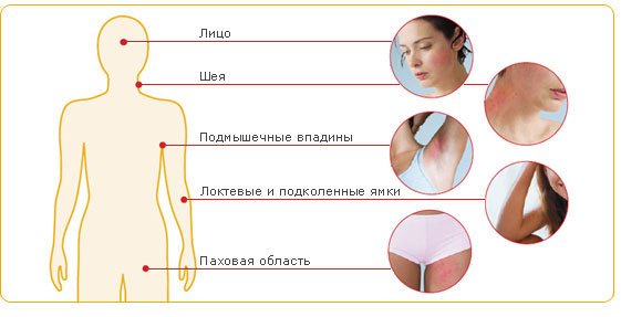 Atopická dermatitida u dospělých: Příznaky a metody léčby