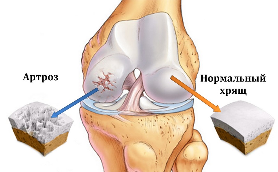 Arthrose: types, les causes, les symptômes et le traitement avec les médicaments et les remèdes populaires
