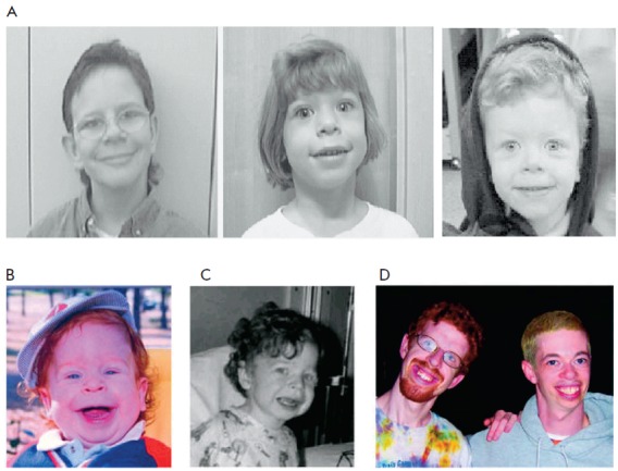 Williams-Syndrom: Was ist das, Symptome, Fotos, Behandlung, Prognose
