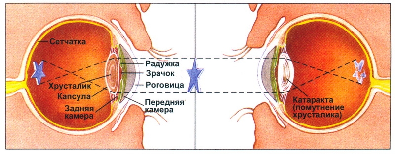 Cataract: Symptoms, Diagnosis, Treatment and Prevention