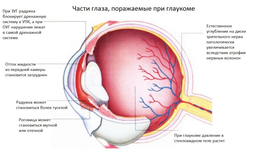 Glavkom: simptomi, vzroki, diagnoza, preprečevanje in zdravljenje