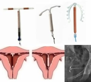 Warum tut der Magen mitten im Zyklus weh, wie vor der Menstruation