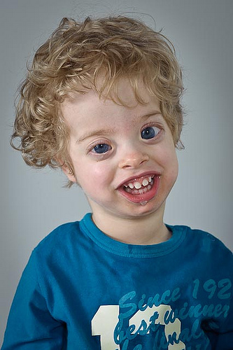 Marshall-syndroom bij kinderen: wat is het, symptomen en behandeling, prognose?