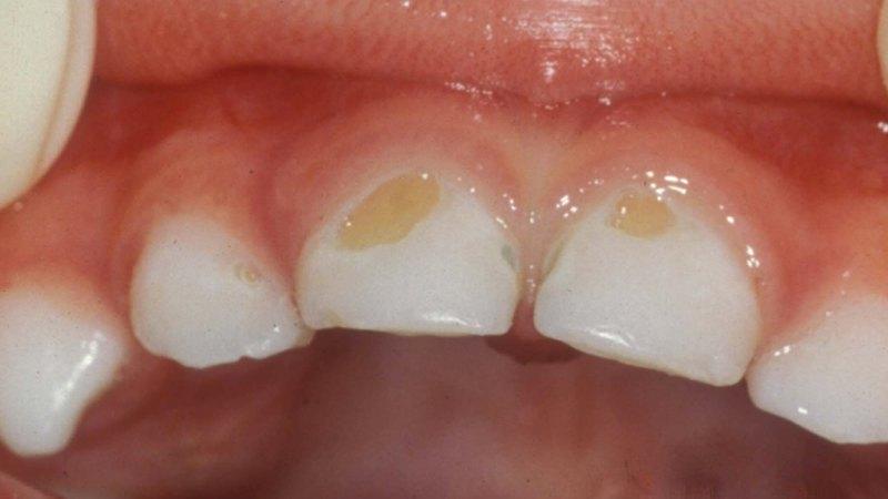 Sorte pletter på tænderne: caries brune pletter