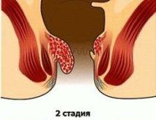 2. etapp