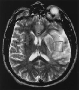 Menschlicher Infarkt