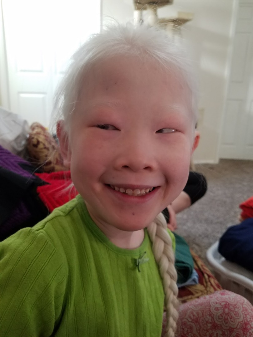 Albinisme okulokutaneus: apa itu, gejala, pengobatan, prognosis