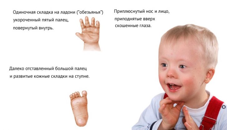 Mental retardering: symptomer, omfang, behandling