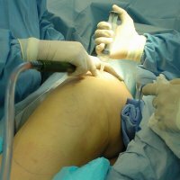 Plastična kirurgija: Liposukcija
