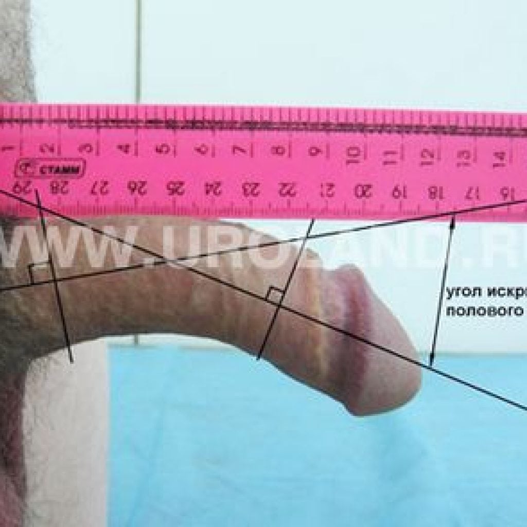 Enfermedad de Peyronie: foto, cómo se ve, síntomas y tratamiento en hombres