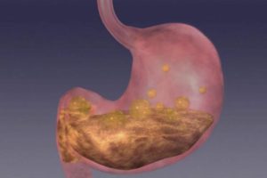Gastritis beim Menschen